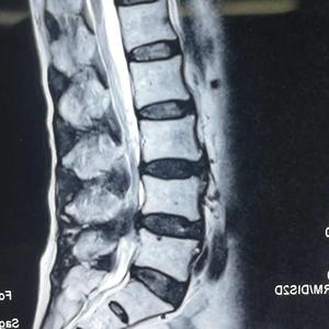 头条问答 左腓骨骨折活动好不好 6个回答